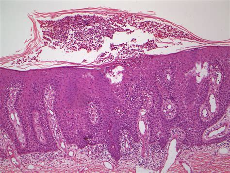 Psoriasiform Dermatitis With A Subcorneal Pustule Hematoxylin And