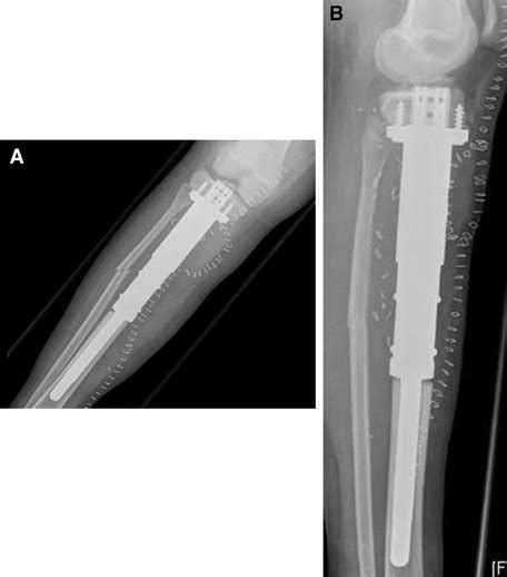 12 Year Old Patient With Ewings Sarcoma Of The Right Diaphyseal Tibia Download Scientific