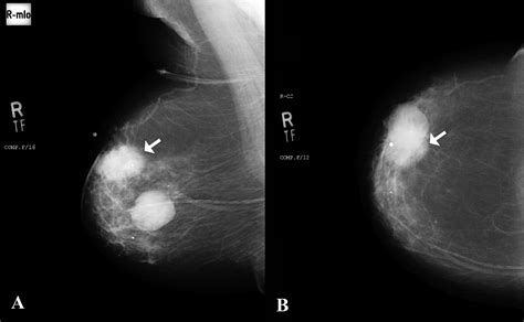 Cureus Utility Of Ultrasound And Mammography In Detection Of Negative