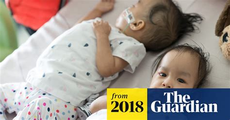 conjoined twins separated but still want to be next to each other video global the guardian