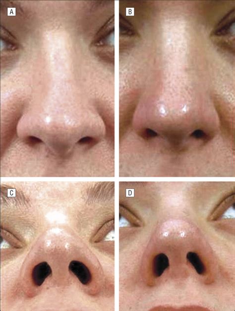 Alar Rim Grafting In Rhinoplasty Facial Plastic Surgery Jama Facial