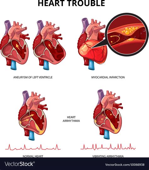 Heart Disease Infographic