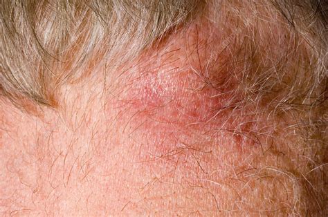 Sebaceous Cyst Stock Image M1300896 Science Photo Library