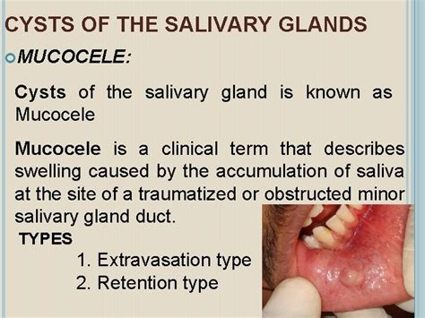 Diseases Of The Salivary Glands The Salivary Glands