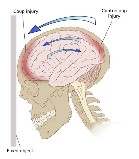 10 Facts Concussions — Cloudy Media Blog