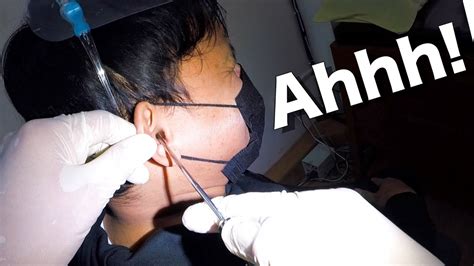 Hard Earwax Removed From Mans Ear Youtube