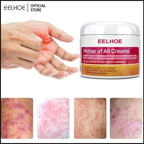 Ubat Gatal Kulit Cream Eczema Losyen Krim Rawatan Eczema Psoriasis