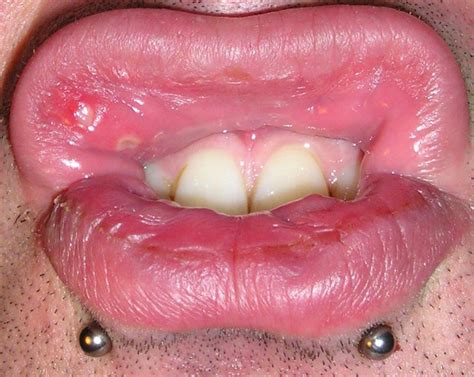Are Mouth Ulcers A Symptom Of Diabetes Diabeteswalls