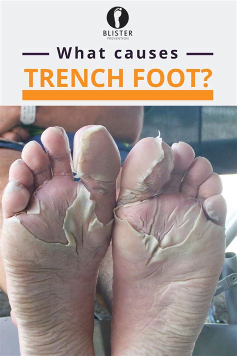 What Causes Trench Foot Macerated Skin Is Water Logged Skin Its White Wrinkly And Weakened