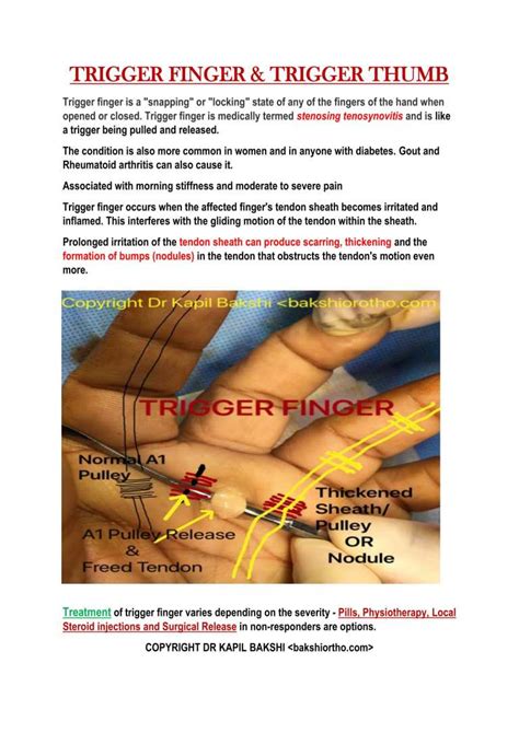 Trigger Finger 1 1 Dr Kapil Bakshi Bakshi Orthopaedics A