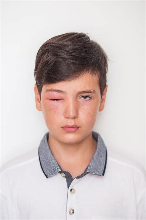 A Boy With Swollen Eye From Insect Bite Quincke Edema Stock Photo