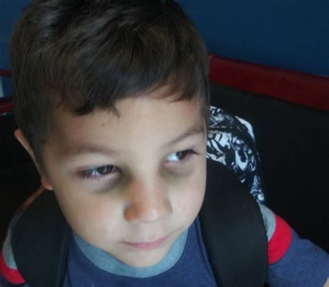 Mom Claims Five Year Old Autistic Son Returns From School With Two Black Eyes Nbc Palm Springs