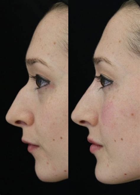 Best Non Surgical Nose Job Harley Street London Phi Clinic
