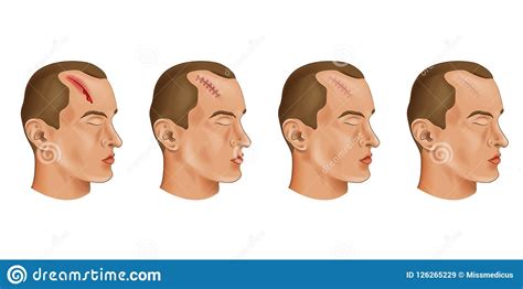 Cut Head Wound Stock Vector Illustration Of Head Healthcare 126265229