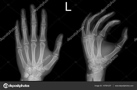 Get 21 Normal Hand Xray Image