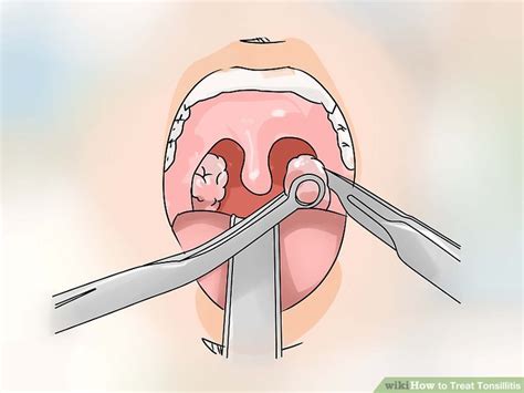 How To Treat Tonsillitis 11 Steps With Pictures Wikihow
