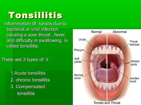 Acute Chronic Tonsillitis And Their Management