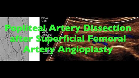 Popliteal Artery Dissection My XXX Hot Girl