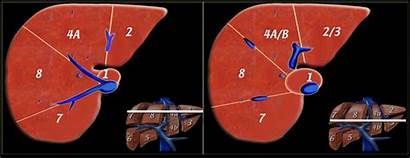 Liver Segments Segment Couinaud Ct Anatomy Laceration