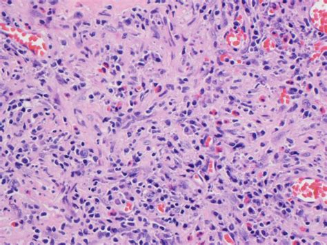 Pathology Outlines Case Of Week 351