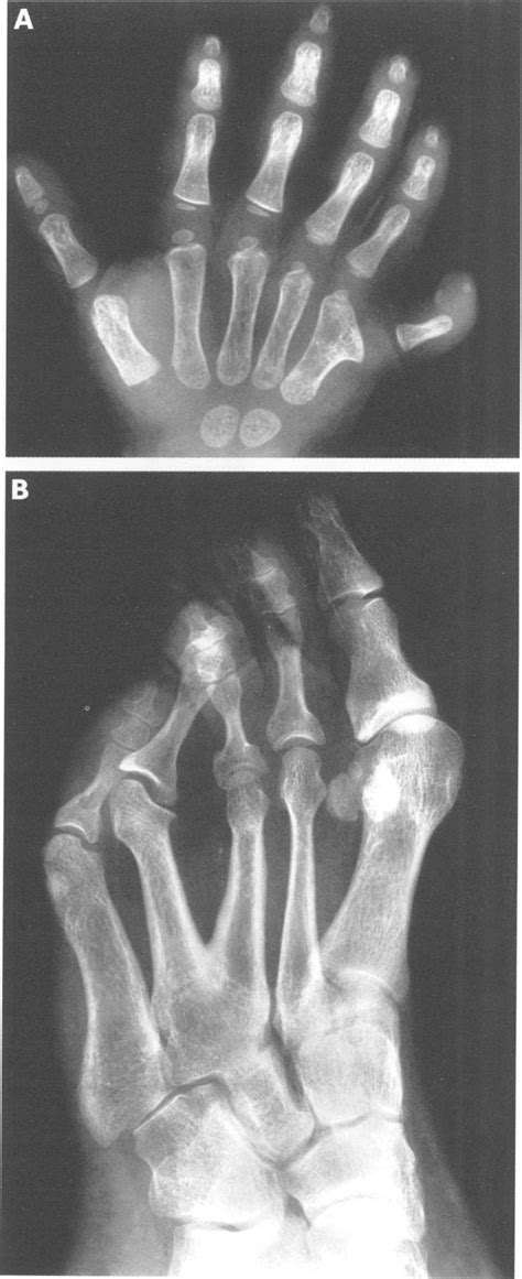Radiographs Of Limb Malformations Seen In Family A Postaxial Download Scientific Diagram