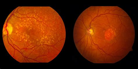 Difference Btw Dry And Wet Age Related Macular Degeneration Irisvision
