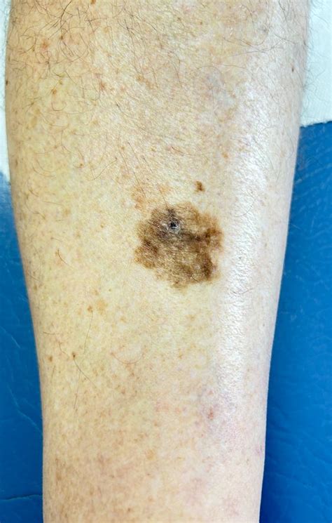 Pictures Of Cancerous Moles What To Look For