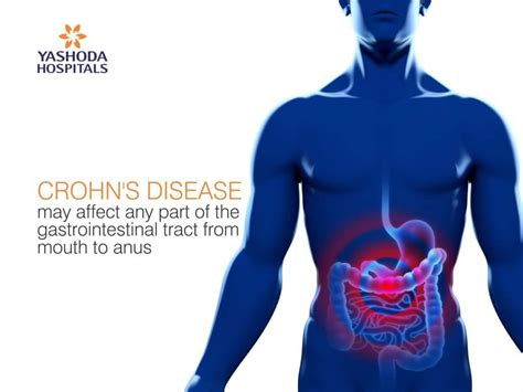 Chrohns Disease Symptoms Causes Diagnosis And Treatment