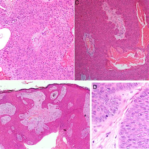 Histology Of Eccrine Porocarcinoma Ep A Ductal Structures Specific