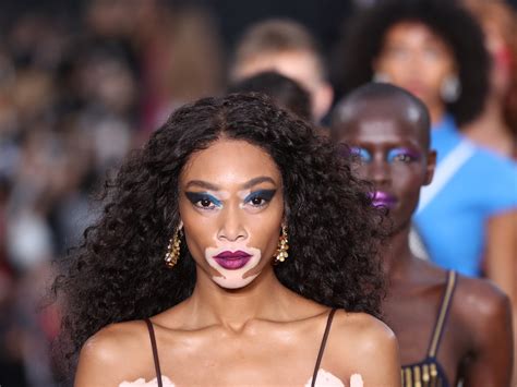 Winnie Harlow Before After