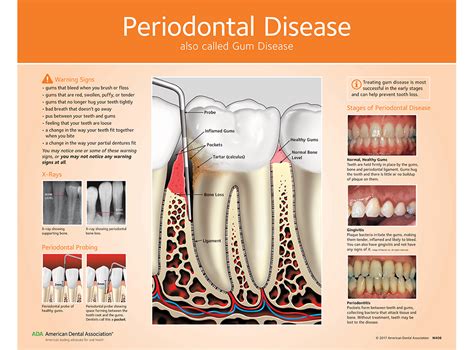 Periodontal Gum Disease Chart For Patient Education Ada W406
