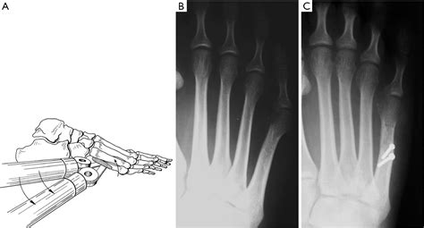 The Bunionette Deformity—evaluation And Management Cooper Annals Of