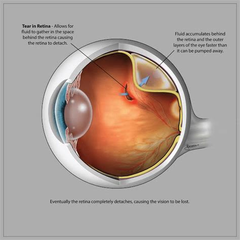 The retina is the layer of specialized nerve tissue lining the back of the eye that what causes a retinal tear and who is at risk? Retinal detachment - Medical OpticsMedical Optics