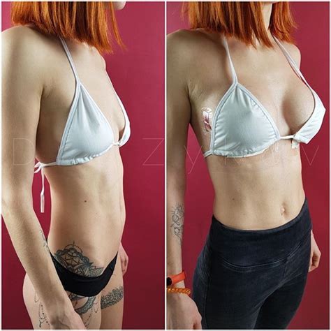 Mammoplasty Before And After Implants 395 Cc Implants Breast Breast Augmentation Breast
