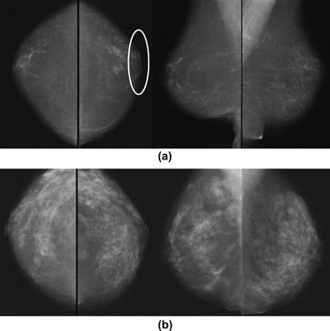 screening for breast cancer post reduction mammoplasty clinical radiology
