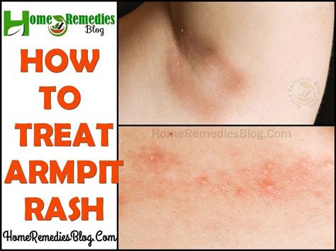 Red Rash Under Armpit Can Be Itchy Irritating And Sometimes Very