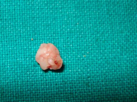 “pyogenic Granuloma Hyperplastic Lesion Of The Gingiva Case Reports”