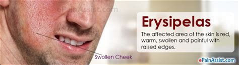Erysipelas Treatment Causes Symptoms Prevention Prognosis