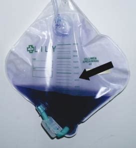 Purple urine bag syndrome is characterized by the urinary drainage bag turning purple in patients on prolonged urinary catheterization, especially those in the bedridden state. Purple Urine Bag - Craig Hospital