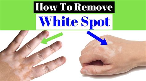 White Spots On Skin Best 4 Remedies To Treat It Youtube