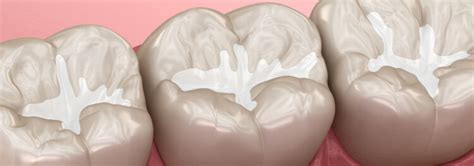 How Dental Sealants Protect Your Teeth Dr Motiwala Dental Clinic