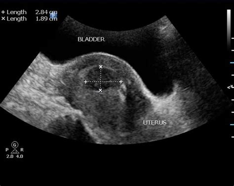 Wk 3 L 2 Good Website Sub Mucosal Leiomyoma Of The Uterus Radiology