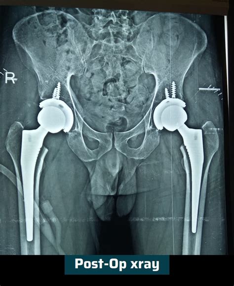 Primary Hip Replacement Surgery Ahmedabad Dr Rachit Sheth