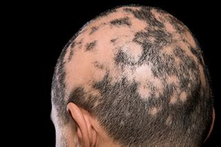 In some cases, health care professionals may use the trade name xeloda when referring to the generic drug name capecitabine. Technique for Minimizing Chemotherapy-Induced Alopecia ...