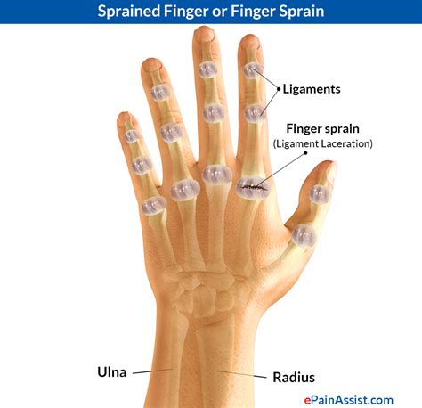 Sprained Thumb Or Skier S Thumb Types Causes Signs Symptoms Treatment