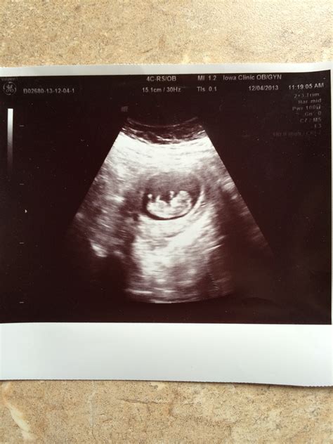 Variety Of Ultrasounds Boy Or Girl