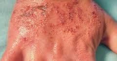Kurap (kadas) adalah penyakit kulit akibat infeksi jamur yang menyerang permukaan kulit. Contoh Gambar Berbagai Jenis Penyakit Gatal dan Obatnya ...