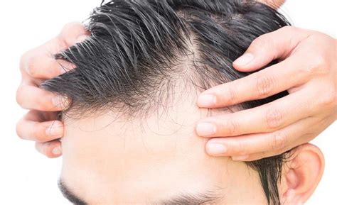 Hair Loss Treatment For Men Advanced Health Solutions Woodstock