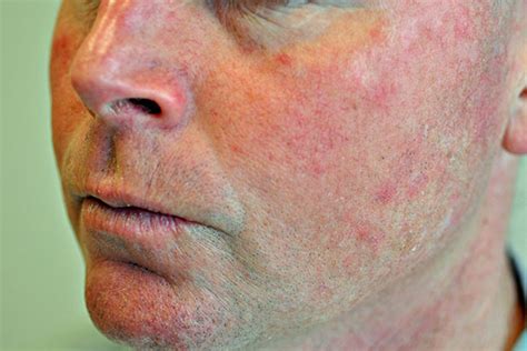 S Weymouth Ma Rosacea Treatment Gk Dermatology