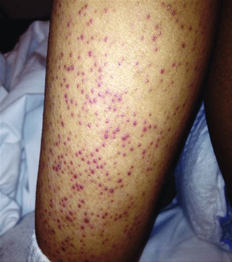 A Non Pruritic Non Painful Petechial Rash On Lower Leg Of 10 Year Old